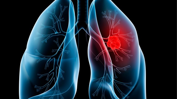 Lung cancer case study hesi